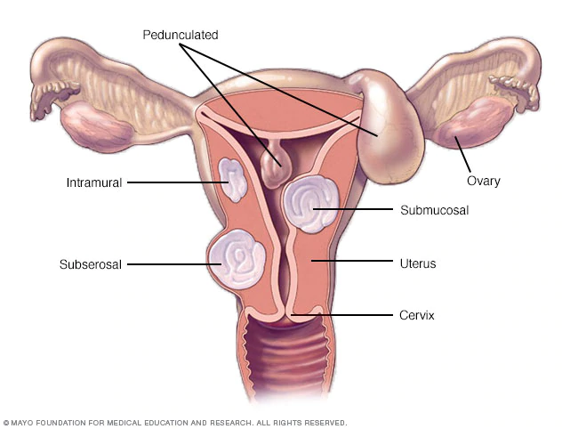 Victoria J Mondloch explains fibroids, the symptoms and the treatments